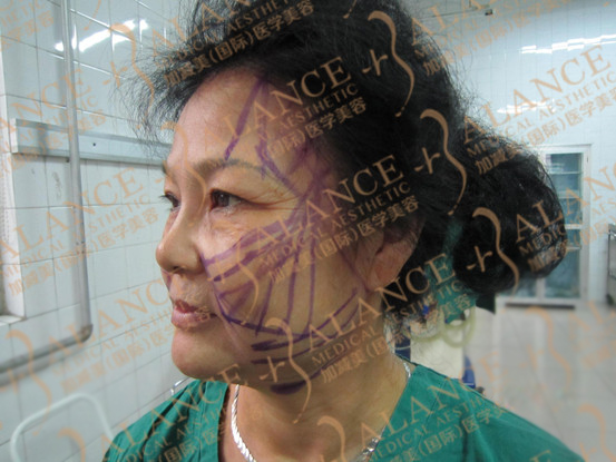 V美减龄案例